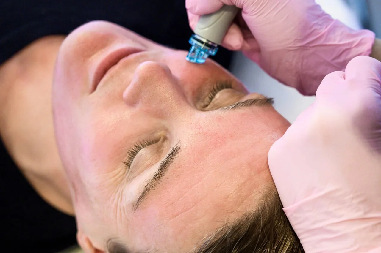 Rosacea treatment at Skinthetics Cosmetics in Düsseldorf