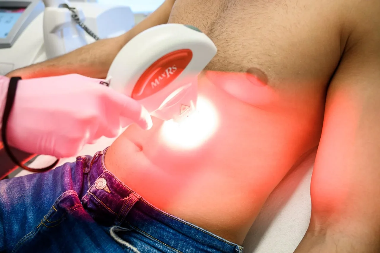IPL hair removal treatment